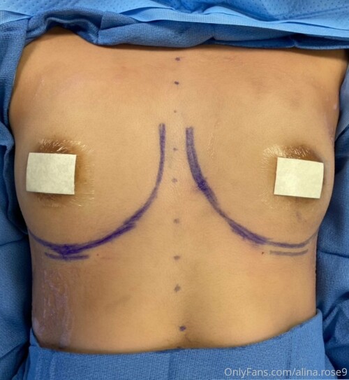 Before and after my boob job once they recover Ill be able to do boob videos and take better pic